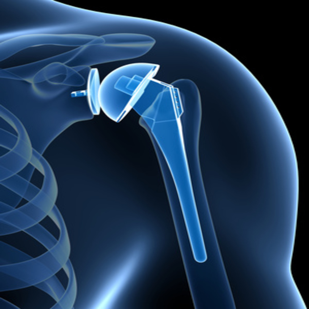 SHOULDER  PROSTHESIS